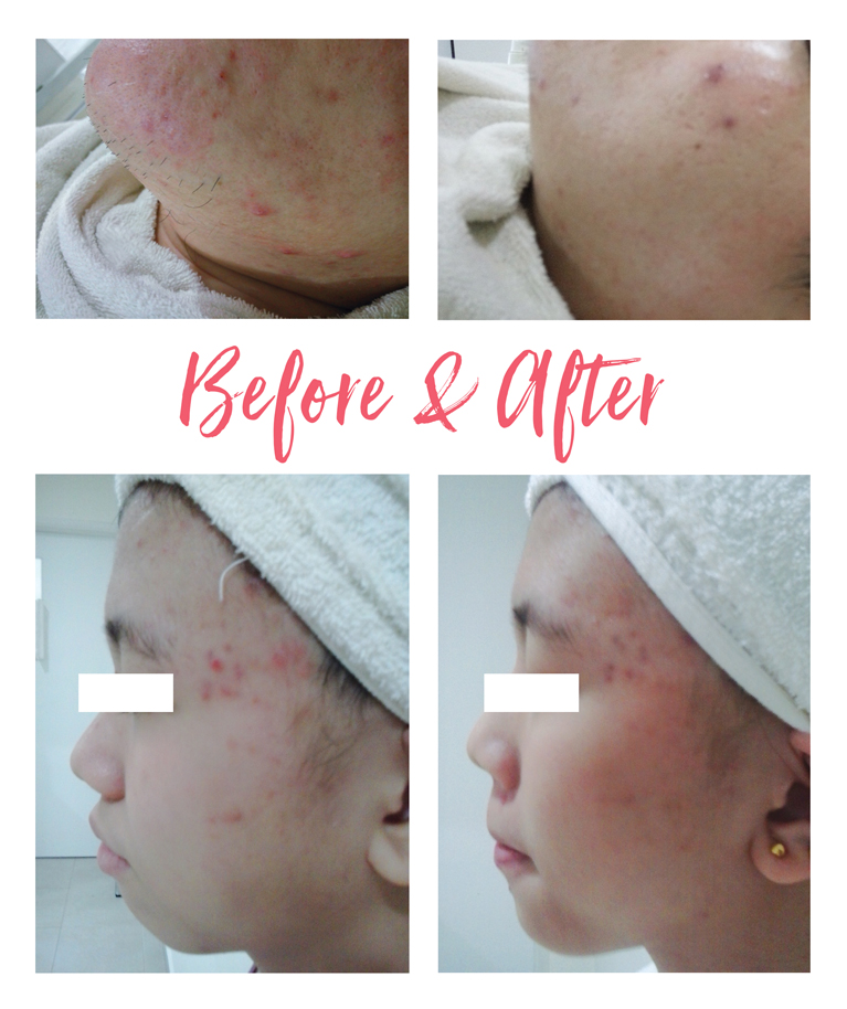 Acne Treatment Module_Before After